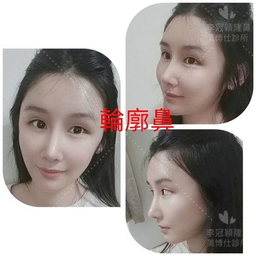 李冠穎醫師:什麼是Y型鼻(Y眉心)?隆鼻都須要墊眉心嗎?Y眉 124481707_3556063044431688_9181783229823673031_o.jpg - 鼻整形