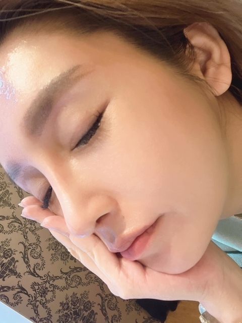 李冠穎醫師:什麼是Y型鼻(Y眉心)?隆鼻都須要墊眉心嗎?Y眉 322865173_578705420449869_5752447846925504027_n.jpeg - 額眉