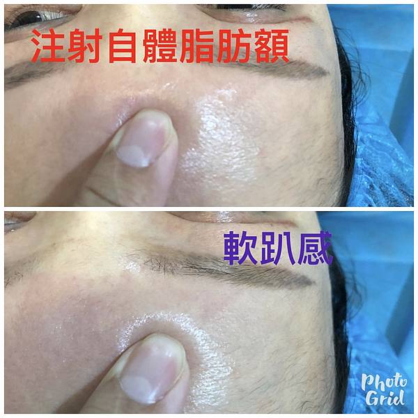 豐額頭或改善額型的方式有那些?它們的優缺點妳明白嗎? 豐額頭或改善額型的方式有那些?它們的優缺點妳明白嗎?