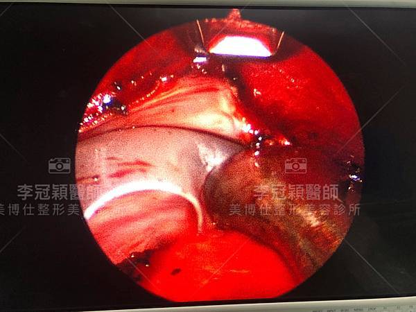 豐額頭或改善額型的方式有那些?它們的優缺點妳明白嗎? 豐額頭或改善額型的方式有那些?它們的優缺點妳明白嗎?