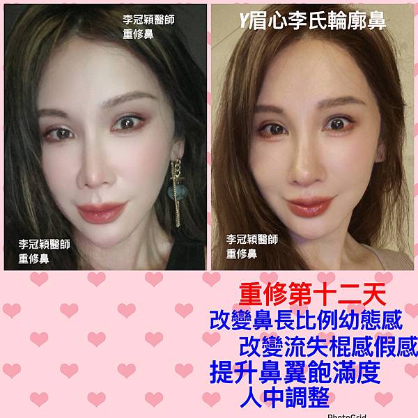 李冠穎醫師:什麼是Y型鼻(Y眉心)?隆鼻都須要墊眉心嗎?Y眉 李冠穎醫師:什麼是Y型鼻(Y眉心)?隆鼻都須要墊眉心嗎?Y眉