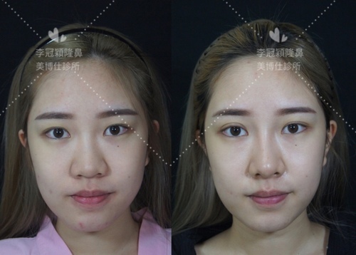 隆鼻最好材料? 誰不容易取出?誰會感染?誰會吸收變形?搶救 IMG_7359.JPG - 鼻整形