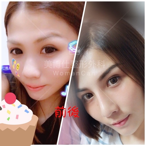 搶救失敗隆鼻三:沒有條件如何隆鼻?正解:輪廓解析隆鼻術(避免 IMG_2858.JPG - 鼻整形