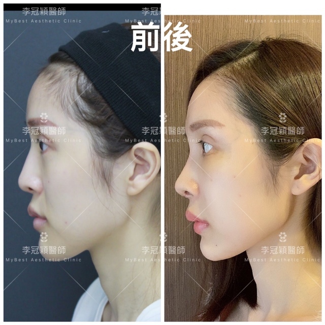 搶救失敗隆鼻三:沒有條件如何隆鼻?正解:輪廓解析隆鼻術(避免 搶救失敗隆鼻三:沒有條件如何隆鼻?正解:輪廓解析隆鼻術(避免