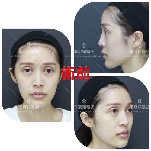 搶救失敗隆鼻三:沒有條件如何隆鼻?正解:輪廓解析隆鼻術(避免 IMG_0420 2.JPG - 鼻整形