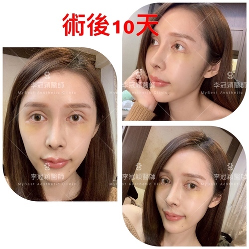 搶救失敗隆鼻三:沒有條件如何隆鼻?正解:輪廓解析隆鼻術(避免 IMG_0421 2.JPG - 鼻整形