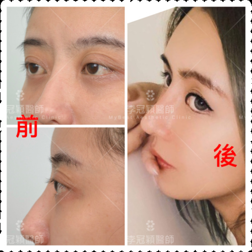 隆鼻最好材料? 誰不容易取出?誰會感染?誰會吸收變形?搶救 IMG_9879.PNG - 墊煤骨