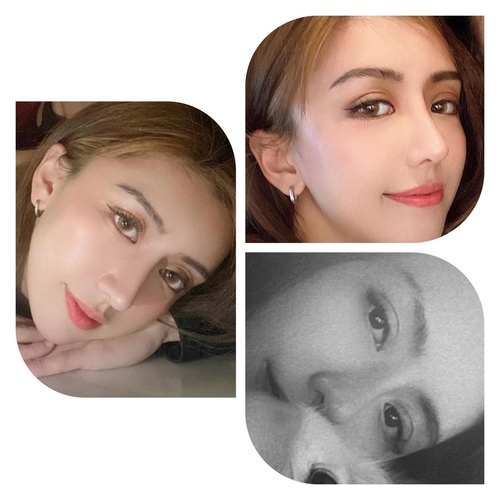 混血眼皮手術：真正的美麗祕訣