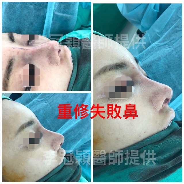 隆鼻最好材料? 誰不容易取出?誰會感染?誰會吸收變形?搶救 41654870_2105387489479807_3105344067488186368_n.jpg - 鼻整形