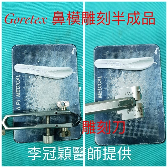 隆鼻最好材料? 誰不容易取出?誰會感染?誰會吸收變形?搶救 隆鼻最好材料? 誰不容易取出?誰會感染?誰會吸收變形?搶救