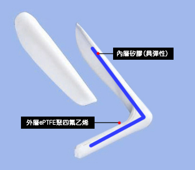 隆鼻最好材料? 誰不容易取出?誰會感染?誰會吸收變形?搶救 隆鼻最好材料? 誰不容易取出?誰會感染?誰會吸收變形?搶救