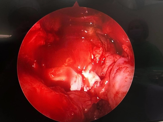 隆鼻最好材料? 誰不容易取出?誰會感染?誰會吸收變形?搶救 隆鼻最好材料? 誰不容易取出?誰會感染?誰會吸收變形?搶救