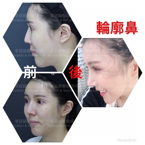 隆鼻最好材料? 誰不容易取出?誰會感染?誰會吸收變形?搶救 IMG_3354.JPG - 鼻整形