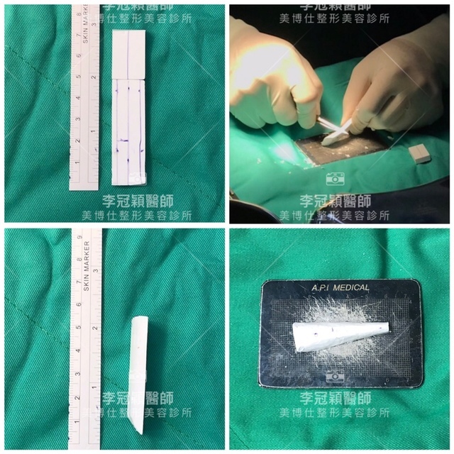 隆鼻最好材料? 誰不容易取出?誰會感染?誰會吸收變形?搶救 IMG_0862.JPG - 鼻整形