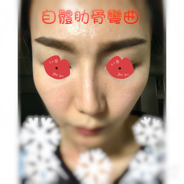 隆鼻最好材料? 誰不容易取出?誰會感染?誰會吸收變形?搶救 隆鼻最好材料? 誰不容易取出?誰會感染?誰會吸收變形?搶救