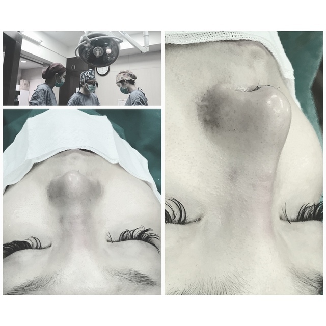 隆鼻最好材料? 誰不容易取出?誰會感染?誰會吸收變形?搶救 隆鼻最好材料? 誰不容易取出?誰會感染?誰會吸收變形?搶救