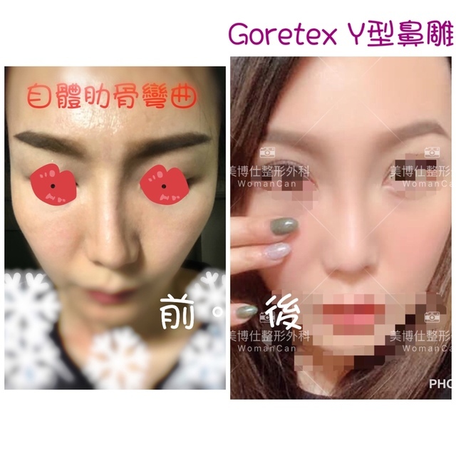 隆鼻最好材料? 誰不容易取出?誰會感染?誰會吸收變形?搶救 隆鼻最好材料? 誰不容易取出?誰會感染?誰會吸收變形?搶救