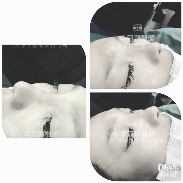 隆鼻最好材料? 誰不容易取出?誰會感染?誰會吸收變形?搶救 隆鼻最好材料? 誰不容易取出?誰會感染?誰會吸收變形?搶救