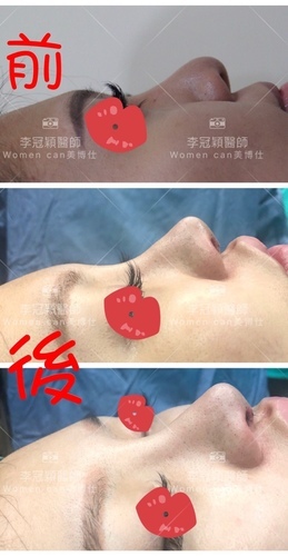 隆鼻最好材料? 誰不容易取出?誰會感染?誰會吸收變形?搶救 IMG_6374.JPG - 1111