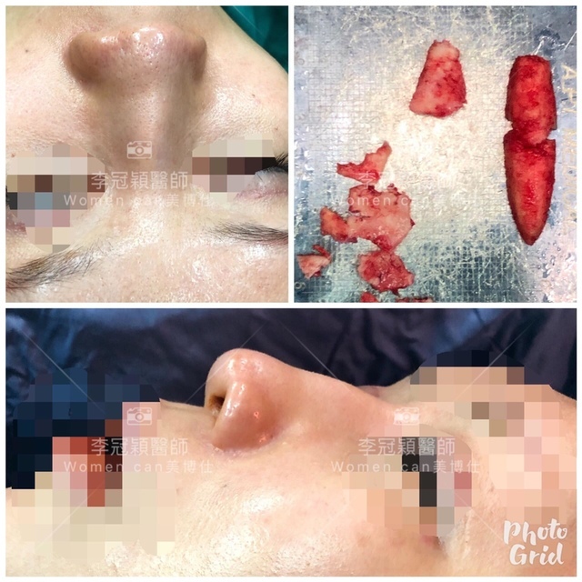 隆鼻最好材料? 誰不容易取出?誰會感染?誰會吸收變形?搶救 隆鼻最好材料? 誰不容易取出?誰會感染?誰會吸收變形?搶救