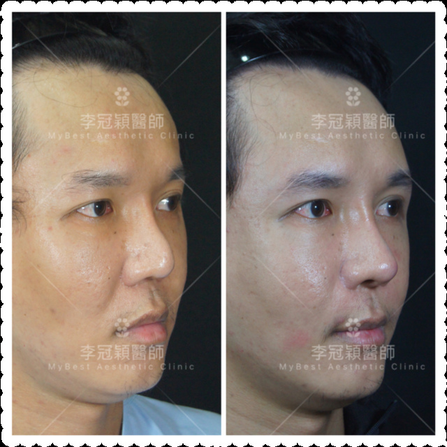 隆鼻最好材料? 誰不容易取出?誰會感染?誰會吸收變形?搶救 隆鼻最好材料? 誰不容易取出?誰會感染?誰會吸收變形?搶救