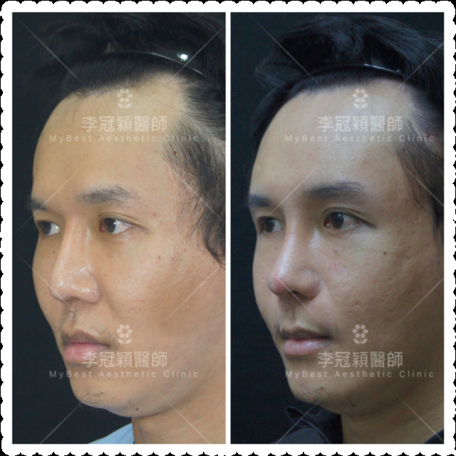 隆鼻最好材料? 誰不容易取出?誰會感染?誰會吸收變形?搶救 隆鼻最好材料? 誰不容易取出?誰會感染?誰會吸收變形?搶救