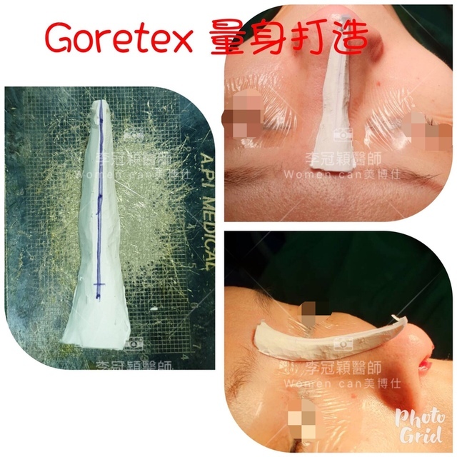 隆鼻最好材料? 誰不容易取出?誰會感染?誰會吸收變形?搶救 隆鼻最好材料? 誰不容易取出?誰會感染?誰會吸收變形?搶救