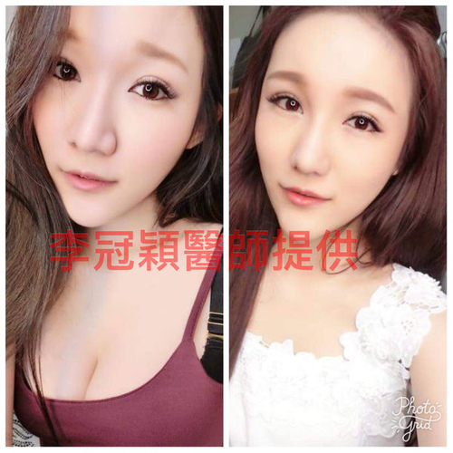 隆鼻最好材料? 誰不容易取出?誰會感染?誰會吸收變形?搶救 1506255322-2272456583_n.jpg - 墊額頭