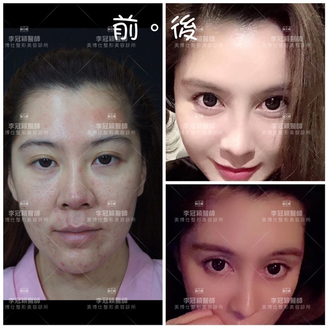 隆鼻最好材料? 誰不容易取出?誰會感染?誰會吸收變形?搶救 隆鼻最好材料? 誰不容易取出?誰會感染?誰會吸收變形?搶救