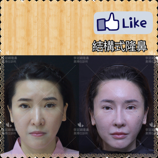 隆鼻最好材料? 誰不容易取出?誰會感染?誰會吸收變形?搶救 隆鼻最好材料? 誰不容易取出?誰會感染?誰會吸收變形?搶救