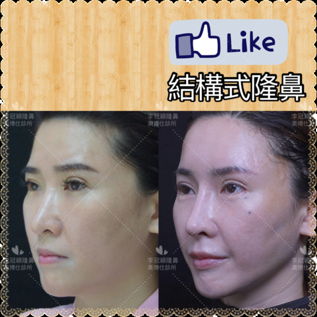 隆鼻最好材料? 誰不容易取出?誰會感染?誰會吸收變形?搶救 隆鼻最好材料? 誰不容易取出?誰會感染?誰會吸收變形?搶救