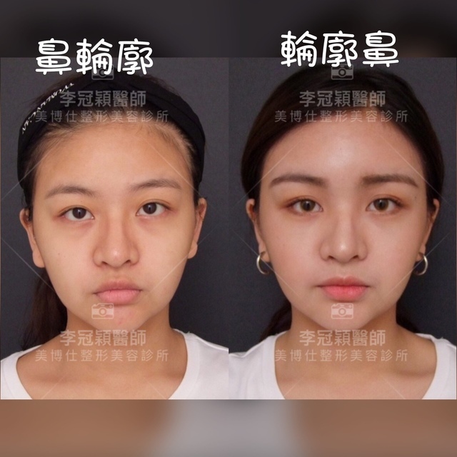 搶救失敗隆鼻三:沒有條件如何隆鼻?正解:輪廓解析隆鼻術(避免 搶救失敗隆鼻三:沒有條件如何隆鼻?正解:輪廓解析隆鼻術(避免