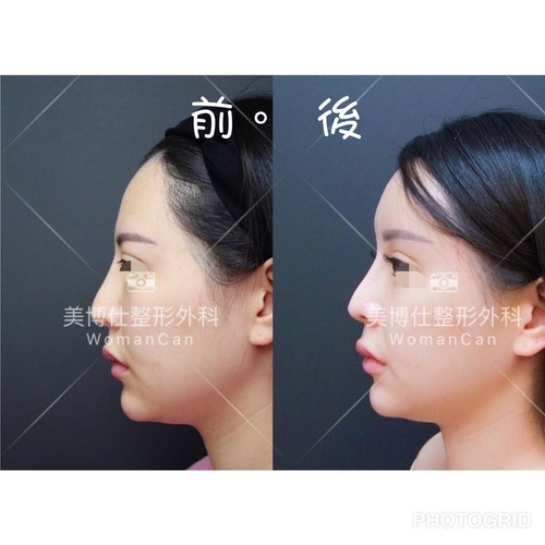 搶救失敗隆鼻三:沒有條件如何隆鼻?正解:輪廓解析隆鼻術(避免 IMG_9481.JPG - 墊額頭