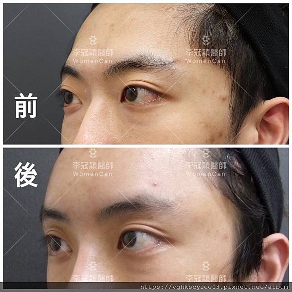 五爪提眉拉皮髮際線會後移嗎?怎麼辦? 五爪提眉拉皮髮際線會後移嗎?怎麼辦?