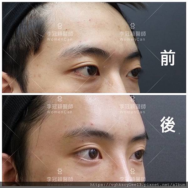 五爪提眉拉皮髮際線會後移嗎?怎麼辦? 五爪提眉拉皮髮際線會後移嗎?怎麼辦?