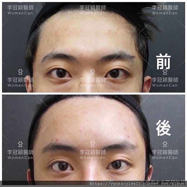 五爪提眉拉皮髮際線會後移嗎?怎麼辦? 五爪提眉拉皮髮際線會後移嗎?怎麼辦?