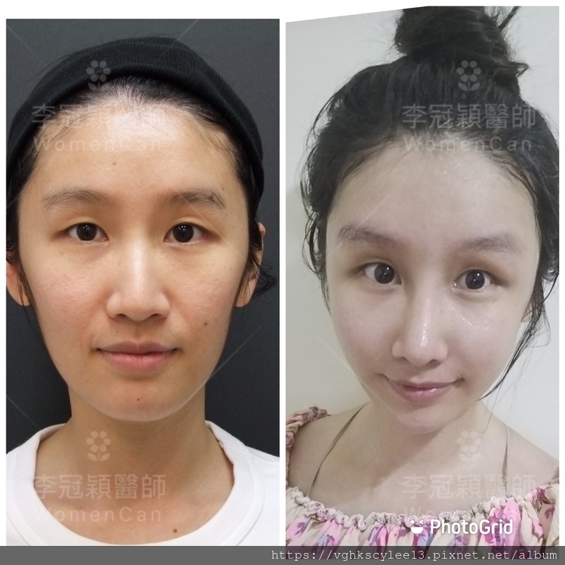 隆鼻最好材料? 誰不容易取出?誰會感染?誰會吸收變形?搶救 隆鼻最好材料? 誰不容易取出?誰會感染?誰會吸收變形?搶救