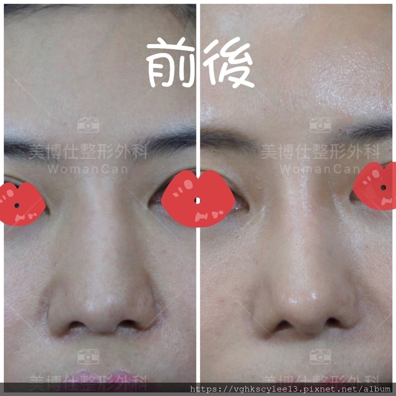 隆鼻最好材料? 誰不容易取出?誰會感染?誰會吸收變形?搶救 隆鼻最好材料? 誰不容易取出?誰會感染?誰會吸收變形?搶救