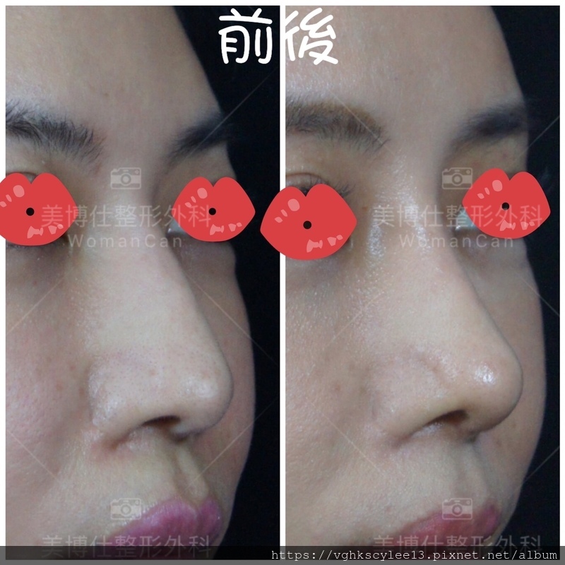 隆鼻最好材料? 誰不容易取出?誰會感染?誰會吸收變形?搶救 隆鼻最好材料? 誰不容易取出?誰會感染?誰會吸收變形?搶救