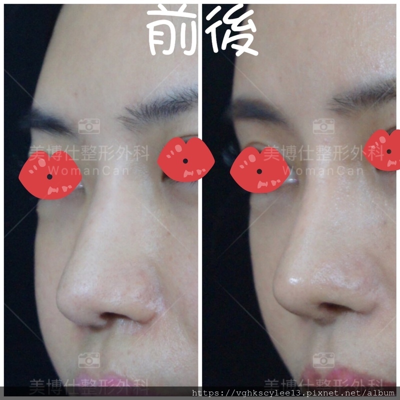 隆鼻最好材料? 誰不容易取出?誰會感染?誰會吸收變形?搶救 隆鼻最好材料? 誰不容易取出?誰會感染?誰會吸收變形?搶救