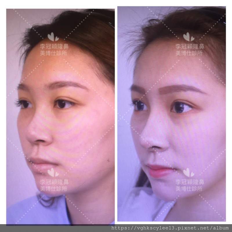 隆鼻最好材料? 誰不容易取出?誰會感染?誰會吸收變形?搶救 隆鼻最好材料? 誰不容易取出?誰會感染?誰會吸收變形?搶救