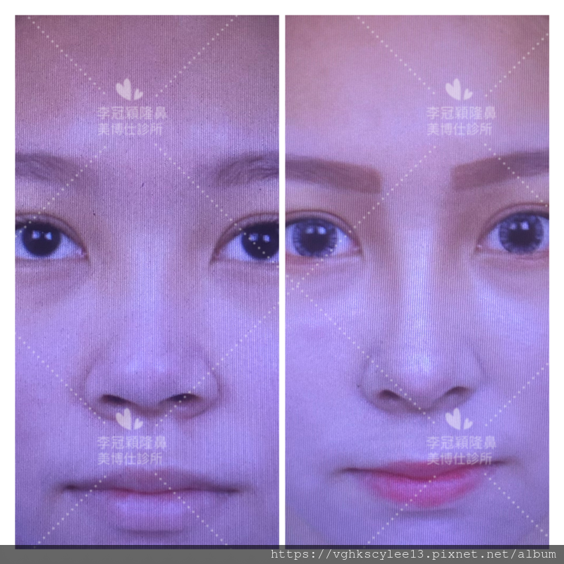 隆鼻最好材料? 誰不容易取出?誰會感染?誰會吸收變形?搶救 隆鼻最好材料? 誰不容易取出?誰會感染?誰會吸收變形?搶救