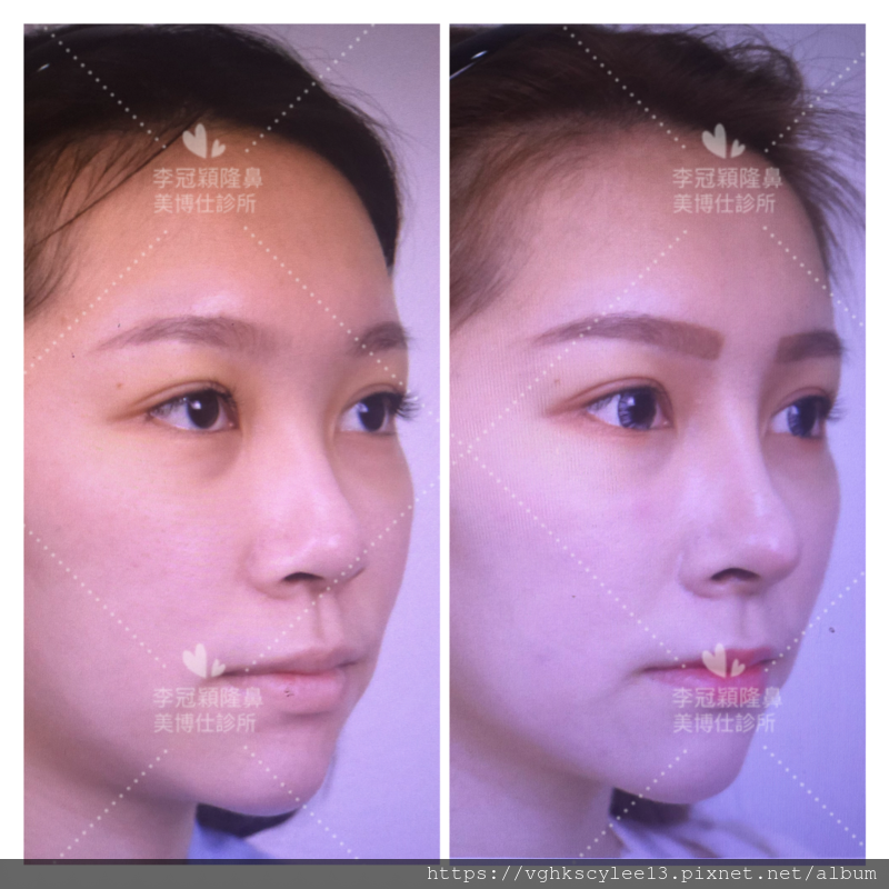 隆鼻最好材料? 誰不容易取出?誰會感染?誰會吸收變形?搶救 隆鼻最好材料? 誰不容易取出?誰會感染?誰會吸收變形?搶救