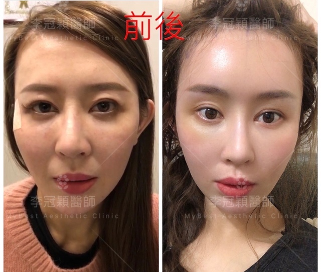 IMG_3753.JPG - 墊額頭