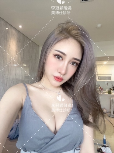 隆鼻最好材料? 誰不容易取出?誰會感染?誰會吸收變形?搶救 IMG_7806.JPG - 鼻整形