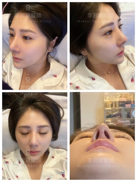 隆鼻最好材料? 誰不容易取出?誰會感染?誰會吸收變形?搶救 S__5824515.jpg - 鼻整形