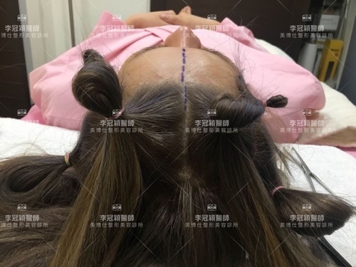 06596843-CF4C-4C7B-8E74-72540A4705C9.jpeg - 內視鏡提眉