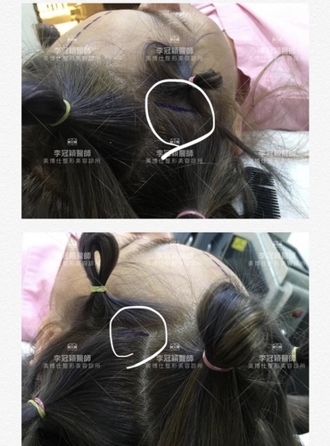 381AC2E4-7FE6-496A-B5D1-648FD69B9301.jpeg - 內視鏡提眉