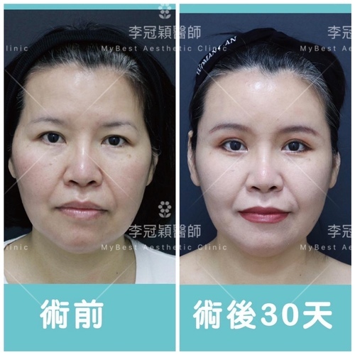 太陽穴凹陷處理：注射填充＆墊片