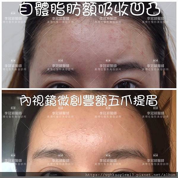 44359382_2153415931343629_7136556957984358400_n.jpg - 墊額頭